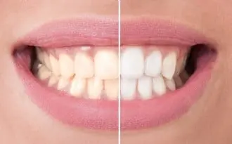 Schonend weiße Zähne vom Zahnhartz Egbert Kunert in Köln